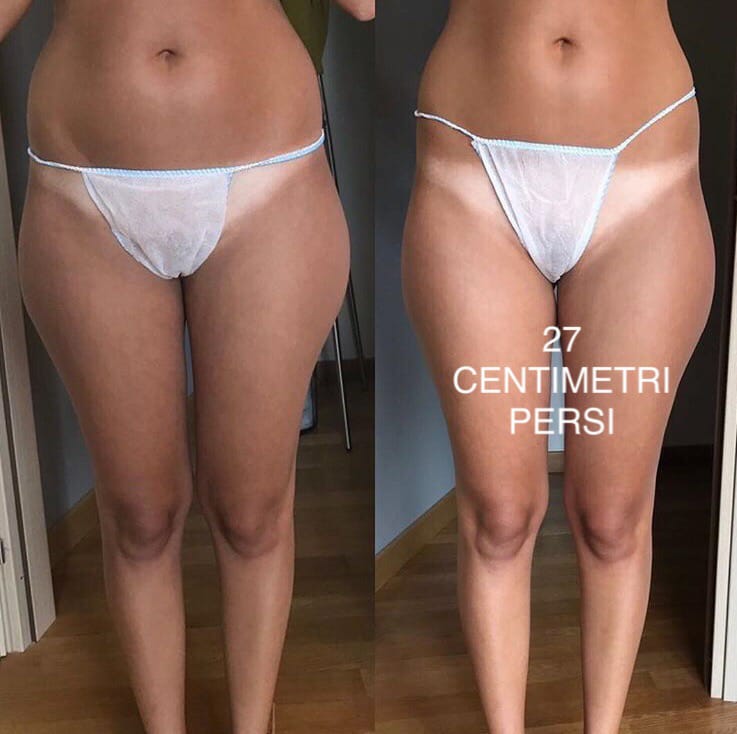 Trattamento Super Snellente