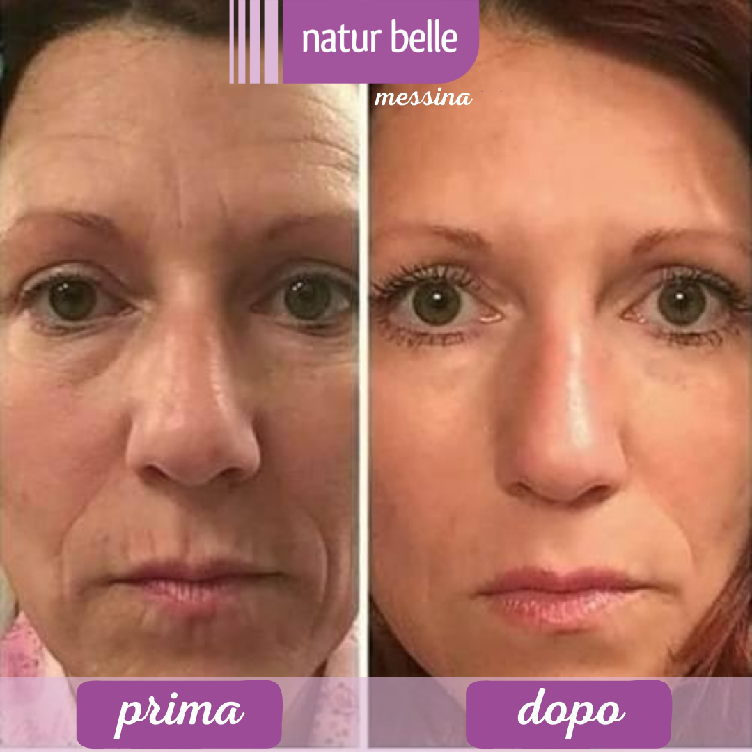 prima dopo lifting viso